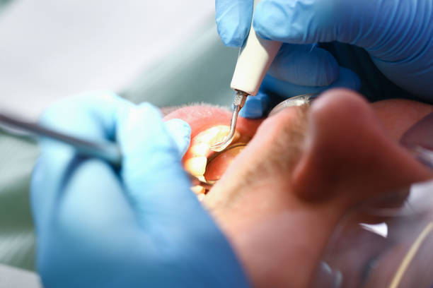 Best Emergency Dentist for Knocked-Out Tooth in Piedmont, AL